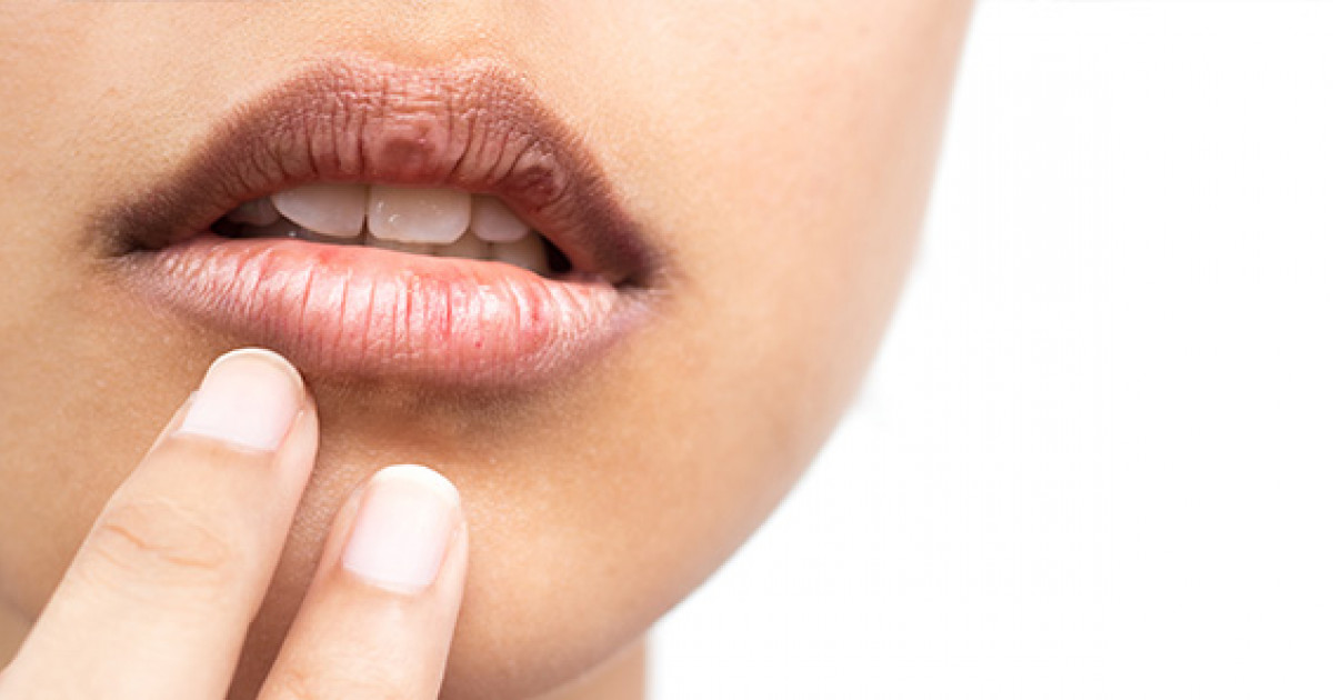 home remedies for dry lips