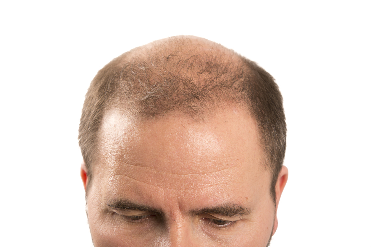 baldness balding causes treatment