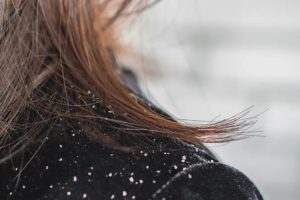 causes of dandruff haircare