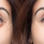 under eye causes treatment symptoms