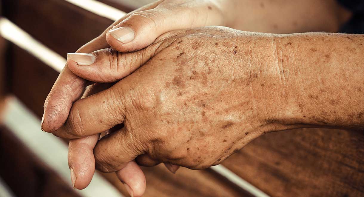 age spots hand remedies treatment methods skin care