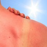 sun burn damaged skin treatments