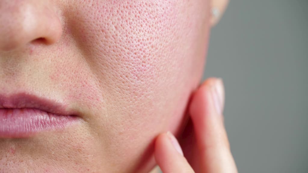 causes of clogged pores in oily skin