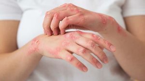skin disorders diseases permanent skin disorders