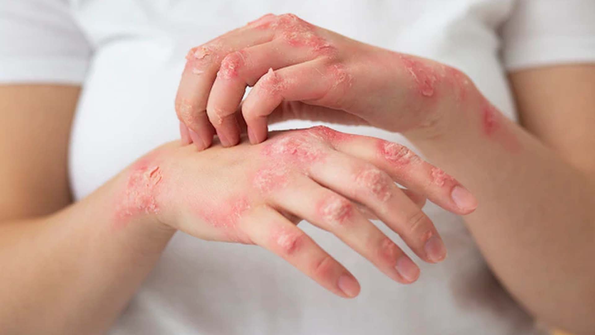 skin disorders and their preventions