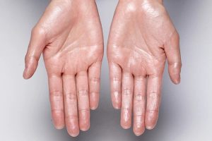 dryness of hands remedies