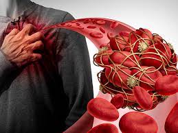 blood clot in lungs heart diseases