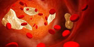 Atherosclerosis - clogged artery High cholesterol