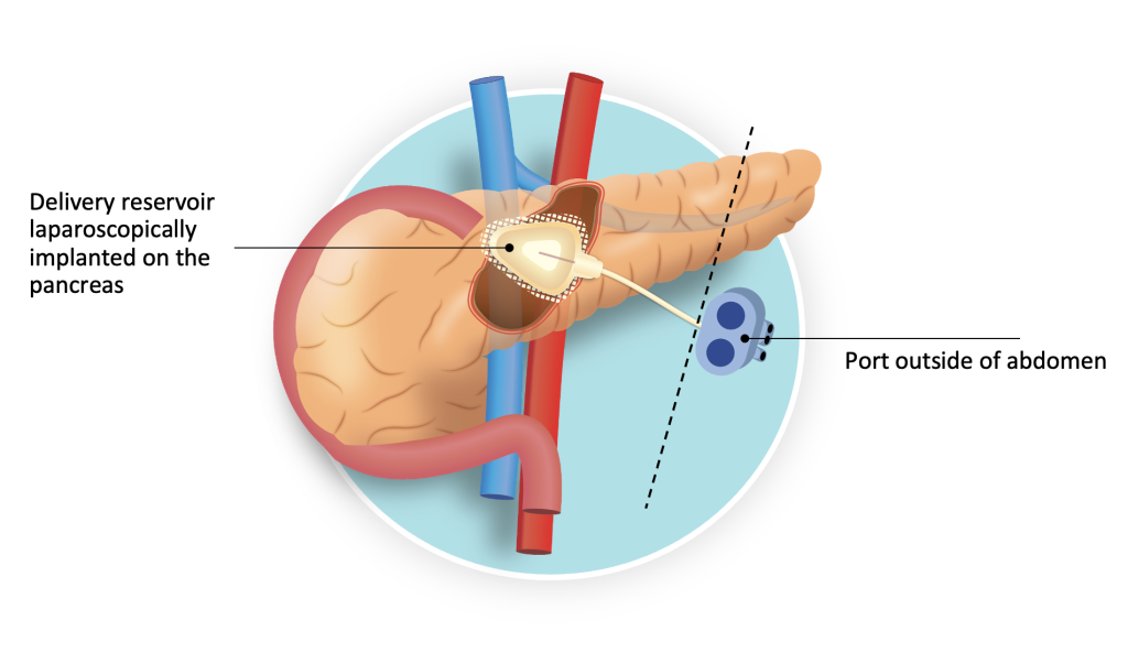 pancreatic cancer implantable device