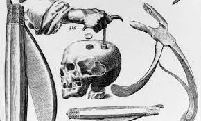trepanation method