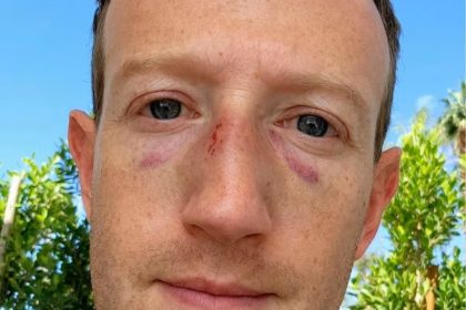 Mark Zuckerberg Shares Selfie with 2 Black Eyes