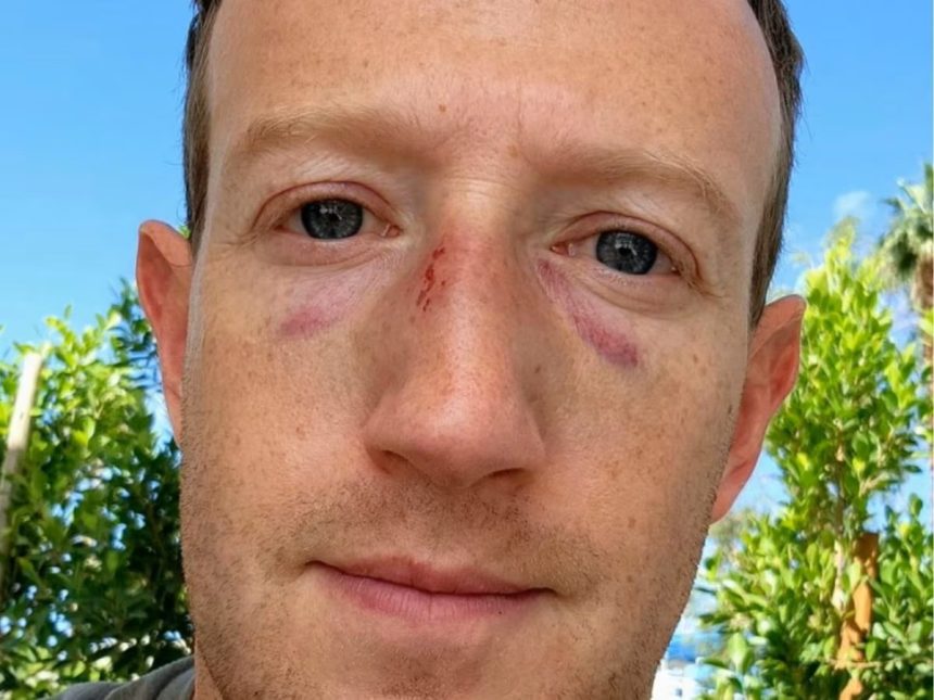 Mark Zuckerberg Shares Selfie with 2 Black Eyes